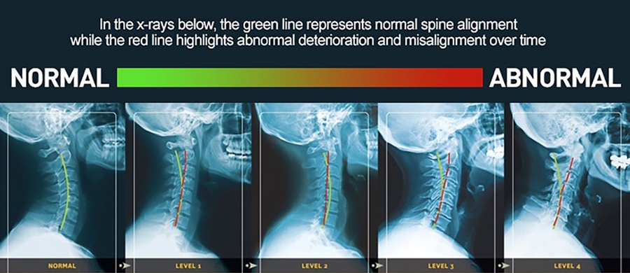 Cervical Kyphosis Demystified Na Img 